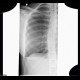 Hydropneumothorax, artifact: X-ray - Plain radiograph